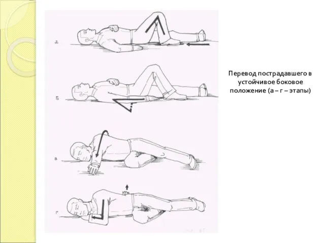 Перевод пострадавшего в устойчивое боковое положение (а – г – этапы)