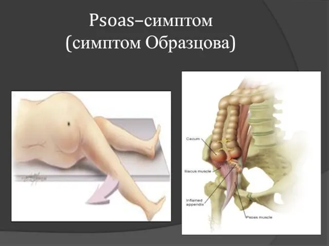 Psoas–симптом (симптом Образцова)