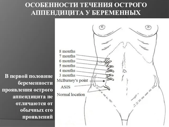 ОСОБЕННОСТИ ТЕЧЕНИЯ ОСТРОГО АППЕНДИЦИТА У БЕРЕМЕННЫХ В первой половине беременности проявления