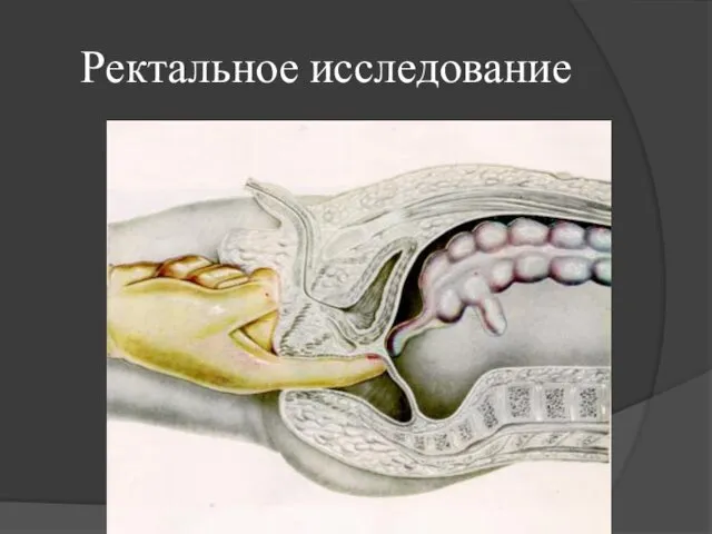 Ректальное исследование