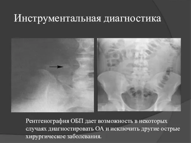 Инструментальная диагностика Рентгенография ОБП дает возможность в некоторых случаях диагностировать ОА