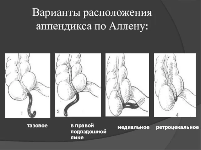 Варианты расположения аппендикса по Аллену: тазовое в правой подвздошной ямке медиальное ретроцекальное