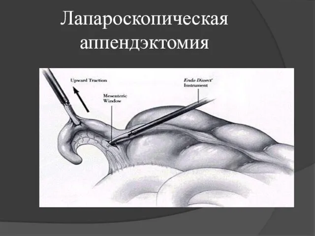 Лапароскопическая аппендэктомия