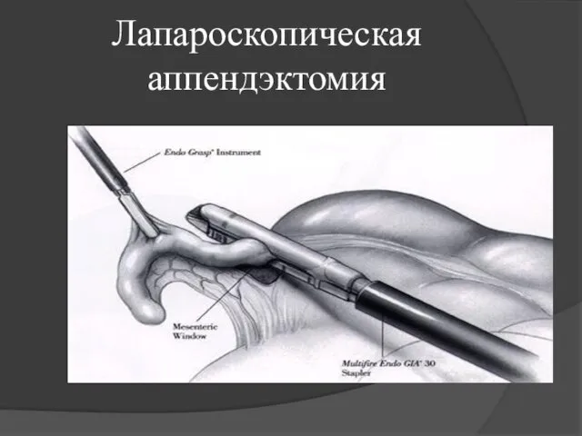 Лапароскопическая аппендэктомия