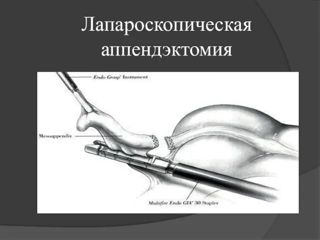 Лапароскопическая аппендэктомия