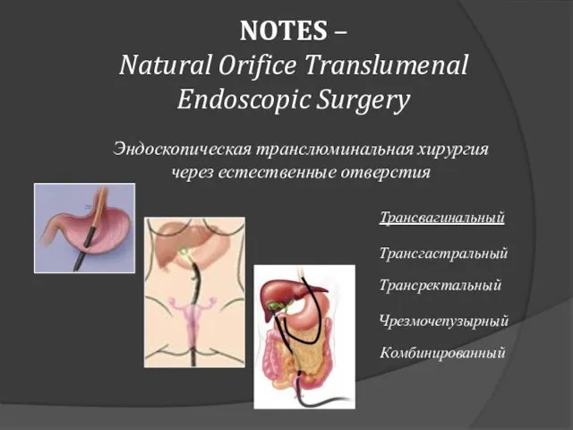 NOTES – Natural Orifice Translumenal Endoscopic Surgery Эндоскопическая транслюминальная хирургия через