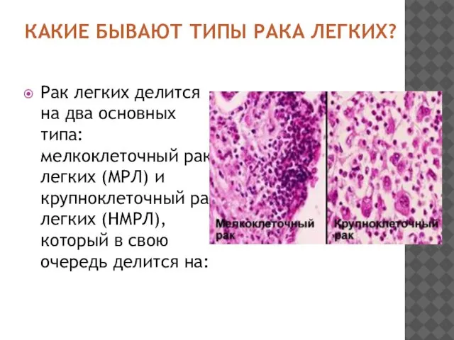 КАКИЕ БЫВАЮТ ТИПЫ РАКА ЛЕГКИХ? Рак легких делится на два основных