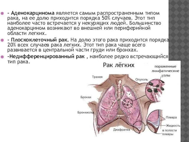 - Аденокарцинома является самым распространенным типом рака, на ее долю приходится