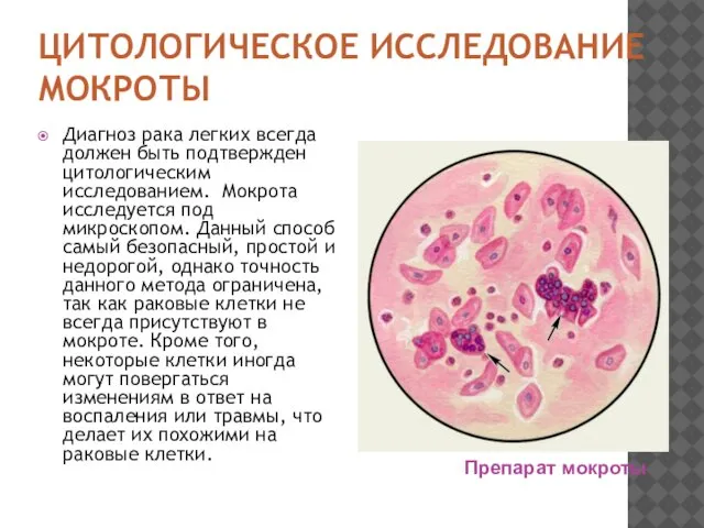 ЦИТОЛОГИЧЕСКОЕ ИССЛЕДОВАНИЕ МОКРОТЫ Диагноз рака легких всегда должен быть подтвержден цитологическим