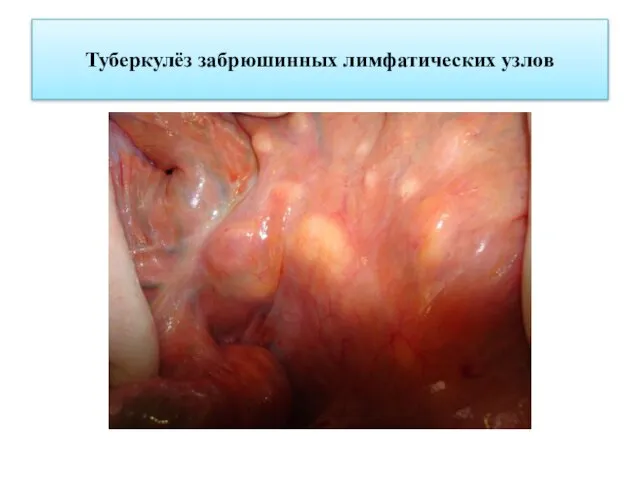 Туберкулёз забрюшинных лимфатических узлов