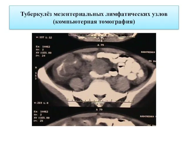 Туберкулёз мезентериальных лимфатических узлов (компьютерная томография)