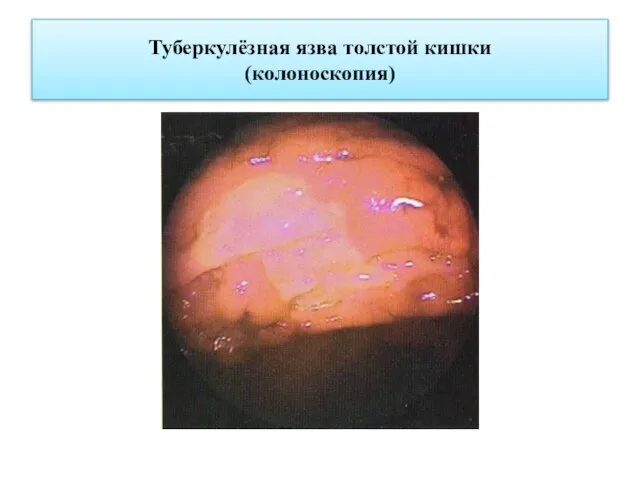 Туберкулёзная язва толстой кишки (колоноскопия)