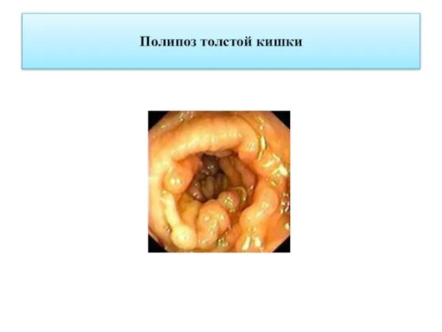 Полипоз толстой кишки