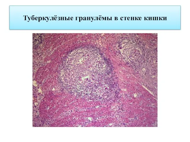 Туберкулёзные гранулёмы в стенке кишки