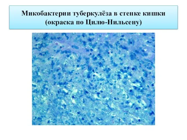 Микобактерии туберкулёза в стенке кишки (окраска по Цилю-Нильсену)