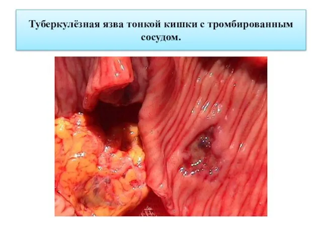 Туберкулёзная язва тонкой кишки с тромбированным сосудом.