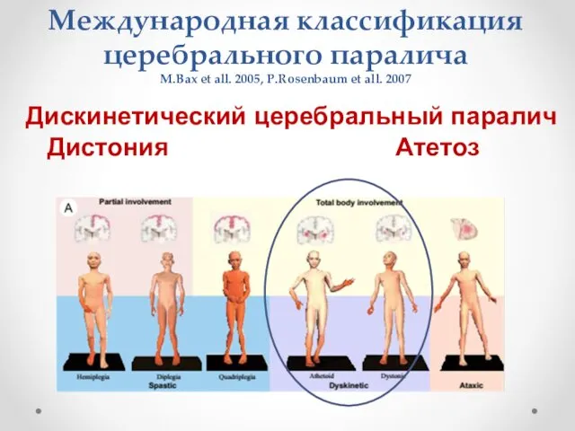 Международная классификация церебрального паралича M.Bax et all. 2005, P.Rosenbaum et all.