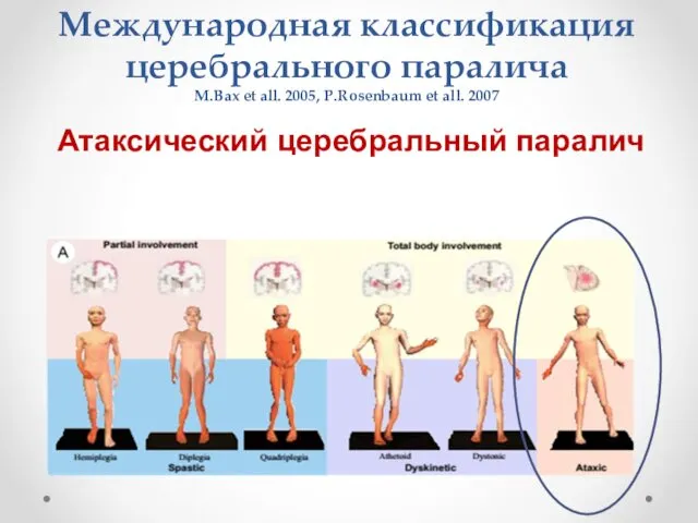 Международная классификация церебрального паралича M.Bax et all. 2005, P.Rosenbaum et all. 2007 Атаксический церебральный паралич