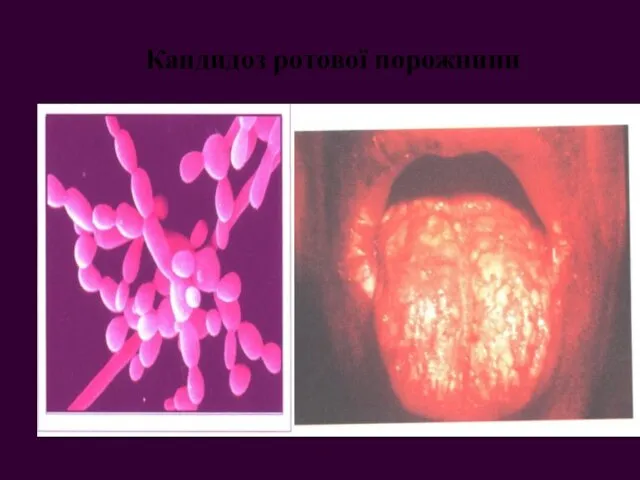 Кандидоз ротової порожнини