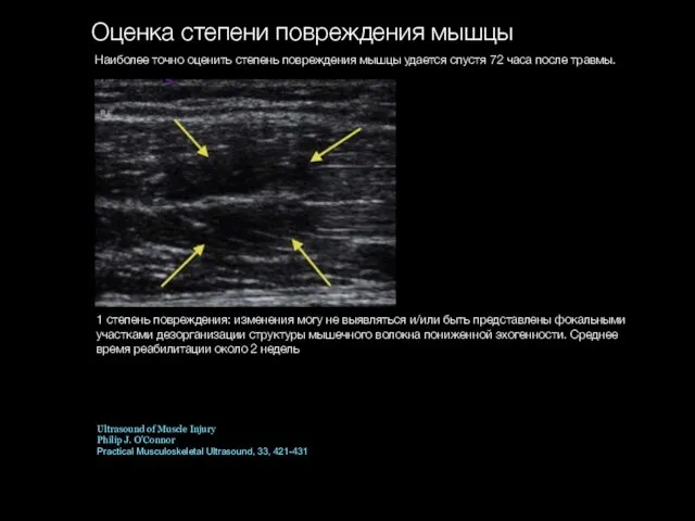 Оценка степени повреждения мышцы Наиболее точно оценить степень повреждения мышцы удается