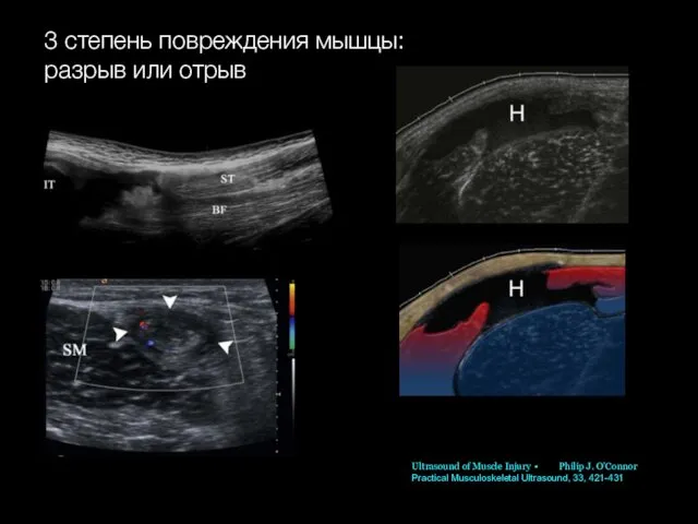 3 степень повреждения мышцы: разрыв или отрыв Ultrasound of Muscle Injury