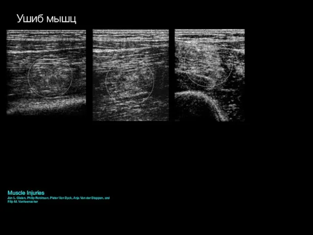 Ушиб мышц Muscle Injuries Jan L. Gielen, Philip Robinson, Pieter Van