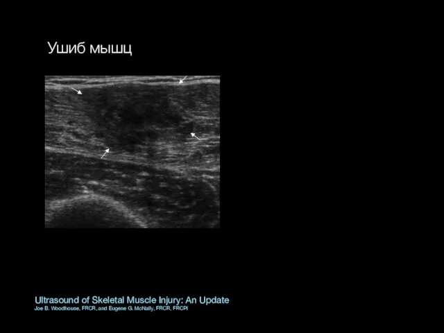 Ultrasound of Skeletal Muscle Injury: An Update Joe B. Woodhouse, FRCR,