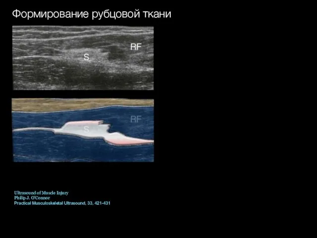 Формирование рубцовой ткани Ultrasound of Muscle Injury Philip J. O'Connor Practical Musculoskeletal Ultrasound, 33, 421-431