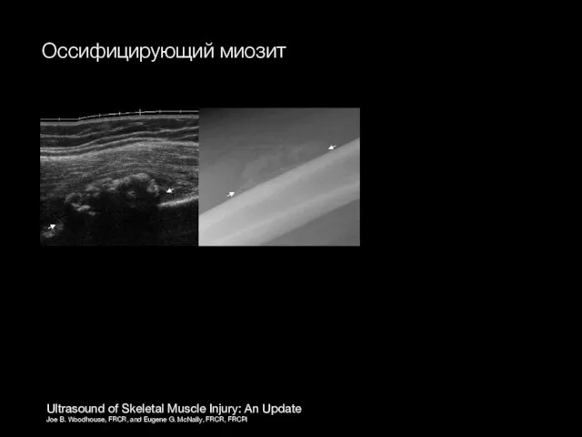 Ultrasound of Skeletal Muscle Injury: An Update Joe B. Woodhouse, FRCR,