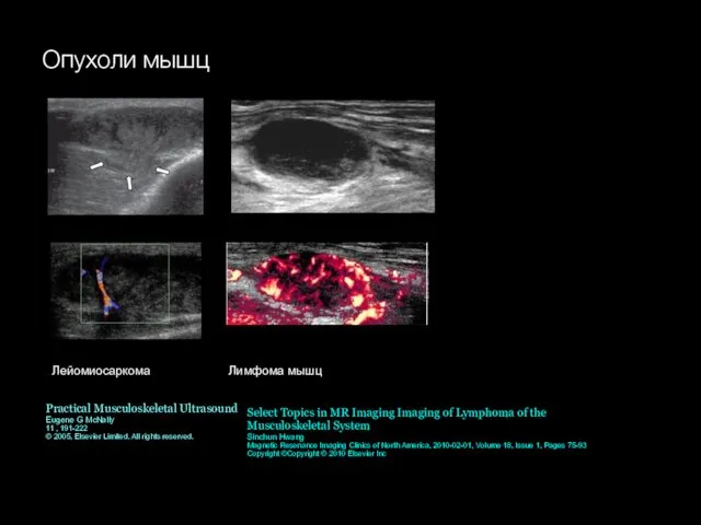 Опухоли мышц Лейомиосаркома Лимфома мышц Practical Musculoskeletal Ultrasound Eugene G McNally