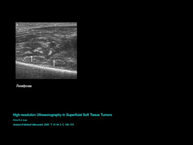 Лимфома High-resolution Ultrasonography in Superficial Soft Tissue Tumors Chiou H.-J. и