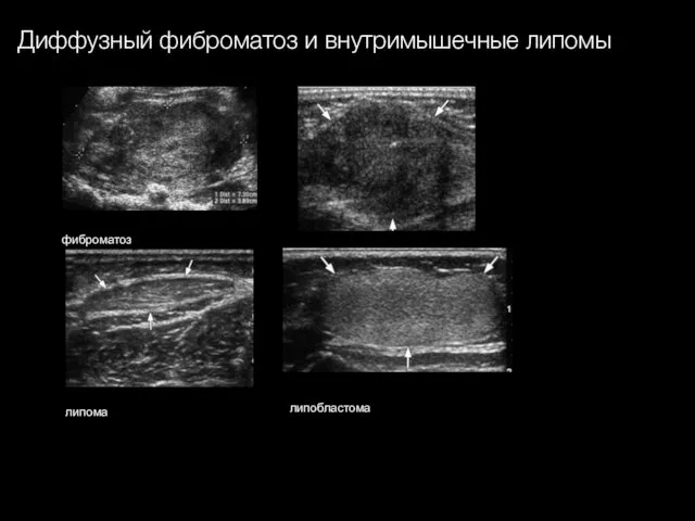 фиброматоз липома липобластома Диффузный фиброматоз и внутримышечные липомы