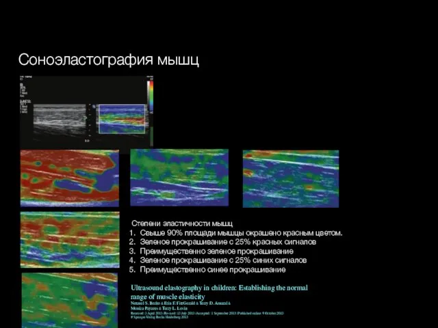 Соноэластография мышц Степени эластичности мышц Свыше 90% площади мышцы окрашено красным