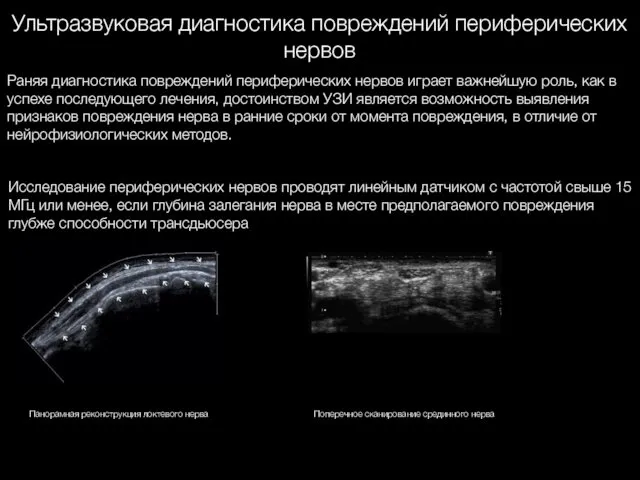 Ультразвуковая диагностика повреждений периферических нервов Исследование периферических нервов проводят линейным датчиком