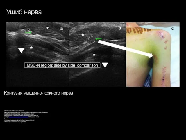 Ушиб нерва 2012 International Federation of Clinical Double site nerve lesion: