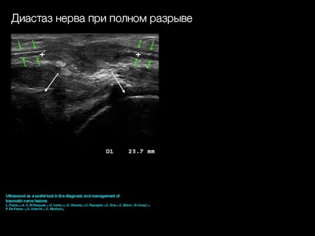 Диастаз нерва при полном разрыве Ultrasound as a useful tool in