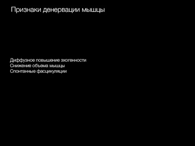 Признаки денервации мышцы Диффузное повышение эхогенности Снижение объема мышцы Спонтанные фасцикуляции