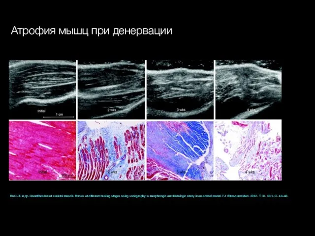 Hu C.-F. и др. Quantification of skeletal muscle fibrosis at different