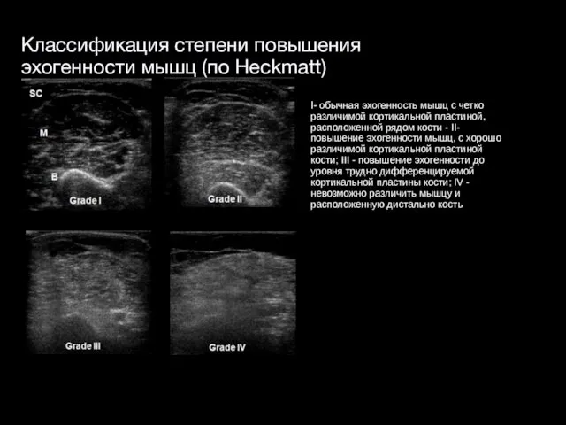 Классификация степени повышения эхогенности мышц (по Heckmatt) I- обычная эхогенность мышц