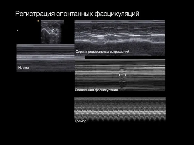 Регистрация спонтанных фасцикуляций Норма Серия произвольных сокращений Спонтанная фасцикуляция Тремор