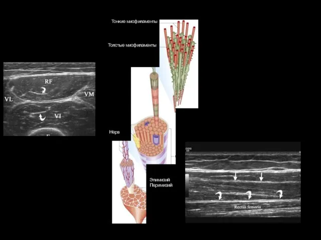 Тонкие миофиламенты Толстые миофиламенты Нерв Эпимизий Перимизий