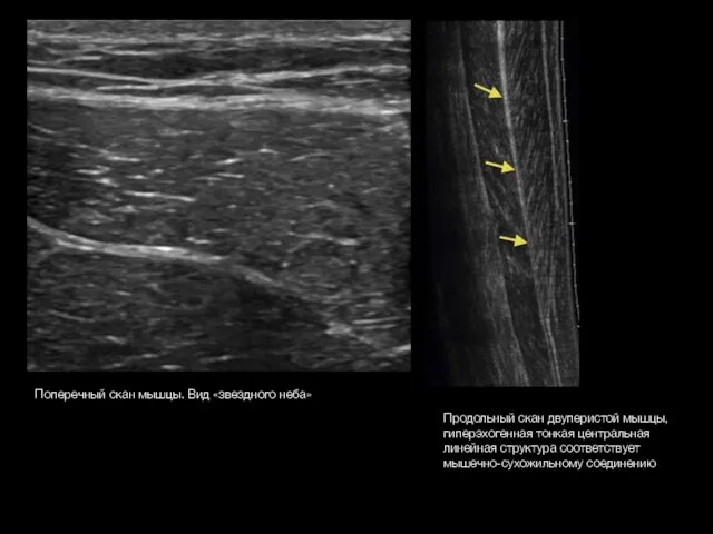 Поперечный скан мышцы. Вид «звездного неба» Продольный скан двуперистой мышцы, гиперэхогенная