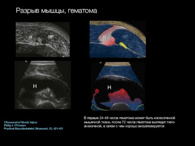 Разрыв мышцы, гематома Ultrasound of Muscle Injury Philip J. O'Connor Practical