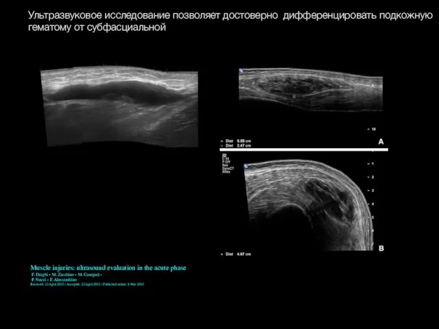 Ультразвуковое исследование позволяет достоверно дифференцировать подкожную гематому от субфасциальной Muscle injuries: