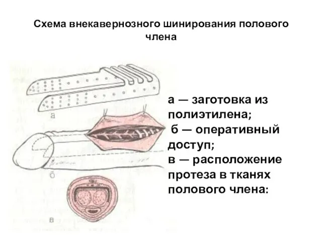 Схема внекавернозного шинирования полового члена а — заготовка из полиэтилена; б