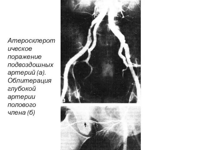 Атеросклеротическое поражение подвоздошных артерий (а). Облитерация глубокой артерии полового члена (б)