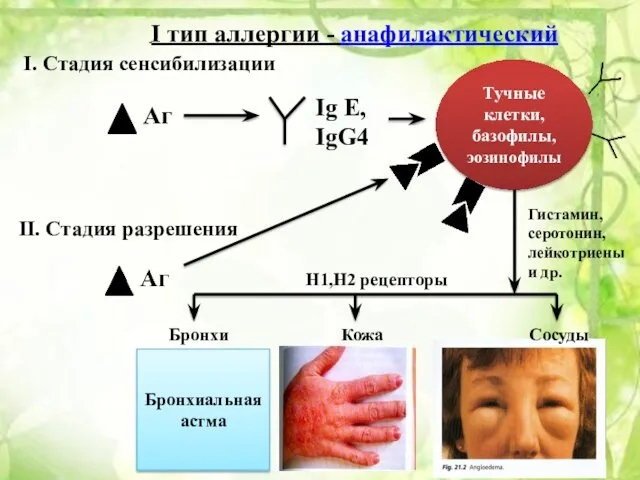 Аг Ig E, IgG4 Тучные клетки, базофилы, эозинофилы II. Стадия разрешения