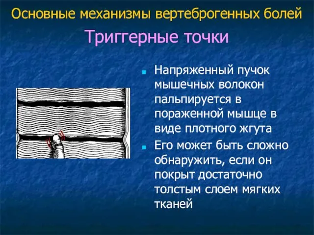 Триггерные точки Напряженный пучок мышечных волокон пальпируется в пораженной мышце в