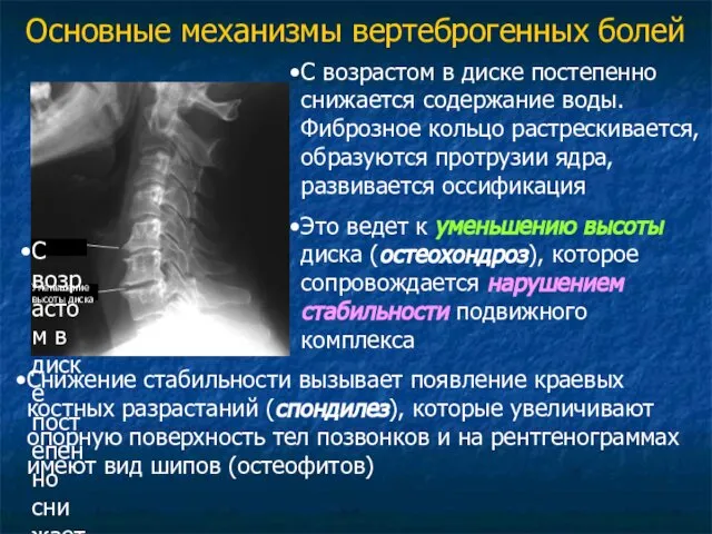 С возрастом в диске постепенно снижается содержание воды. Фиброзное кольцо растрескивается,