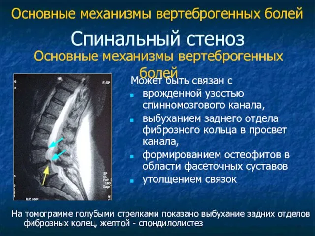 Спинальный стеноз Может быть связан с врожденной узостью спинномозгового канала, выбуханием